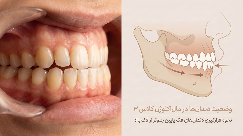 دندانهای ناهنجاری کلاس ۳ و جلو بودن فک پایین