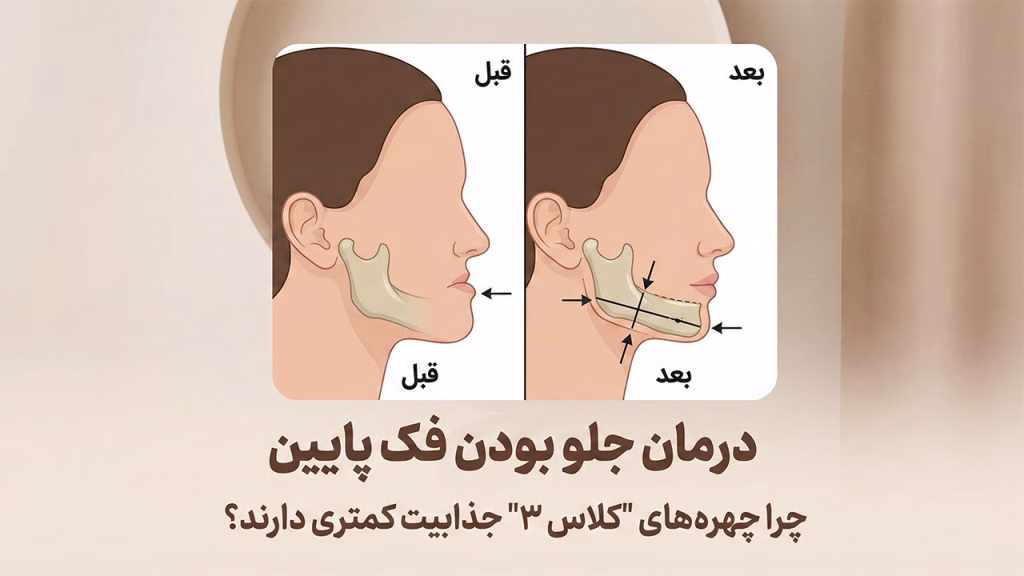 جراحی فک پایین جلو آمده یا پروگناتیسم