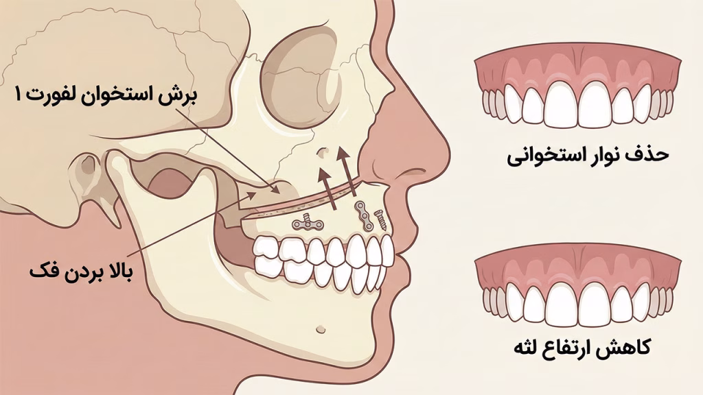 جراحی فک بالا برای کاهش ارتفاع لثه
