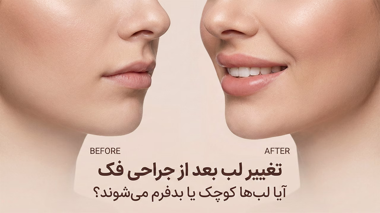 تغییر لب بعد از جراحی فک