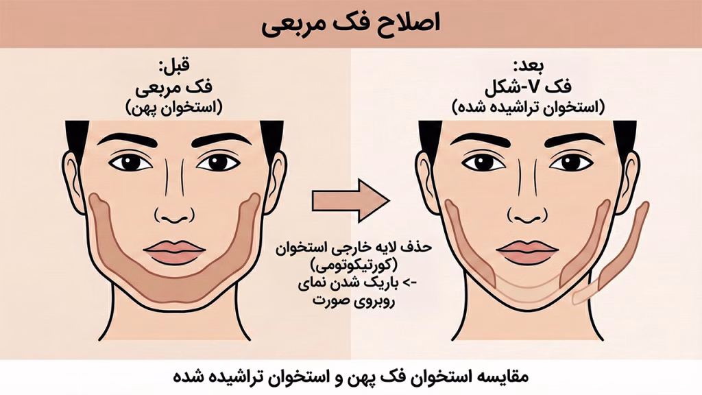 کاهش زاویه فک پایین با جراحی