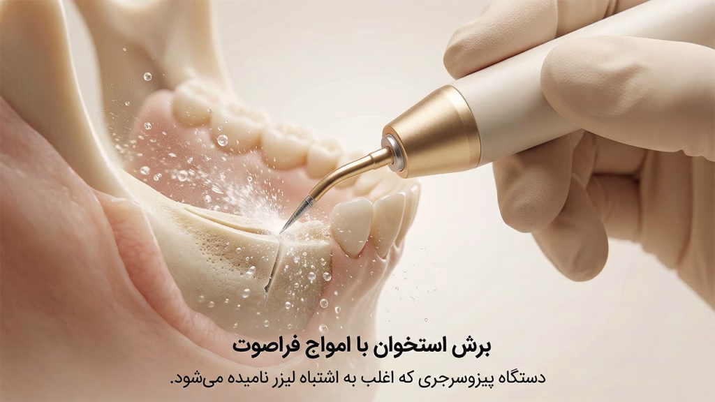 دستگاه پیزوسرجری برای برش استخوان فک