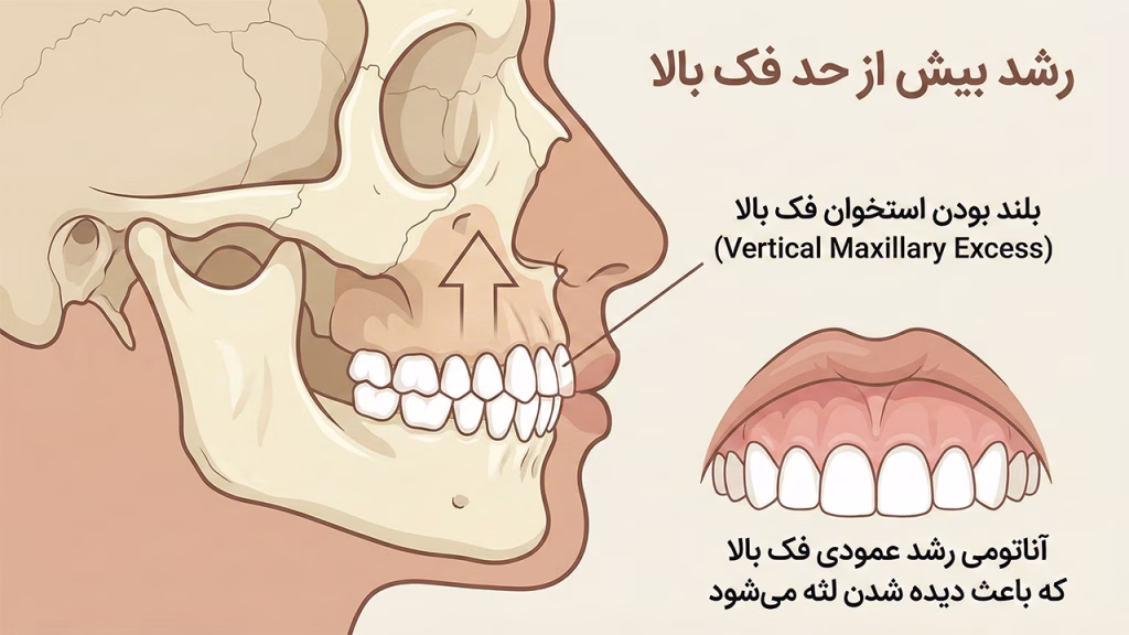 علت استخوانی لبخند لثه ای