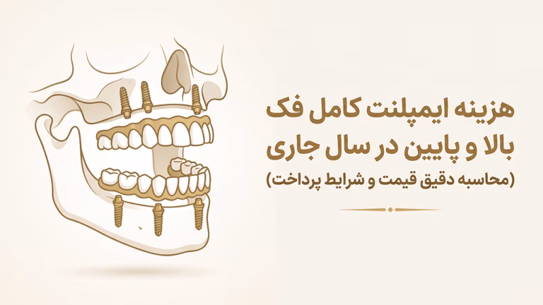 قیمت فک کامل ایمپلنت در شمال شرق تهران و بررسی هزینه‌ها