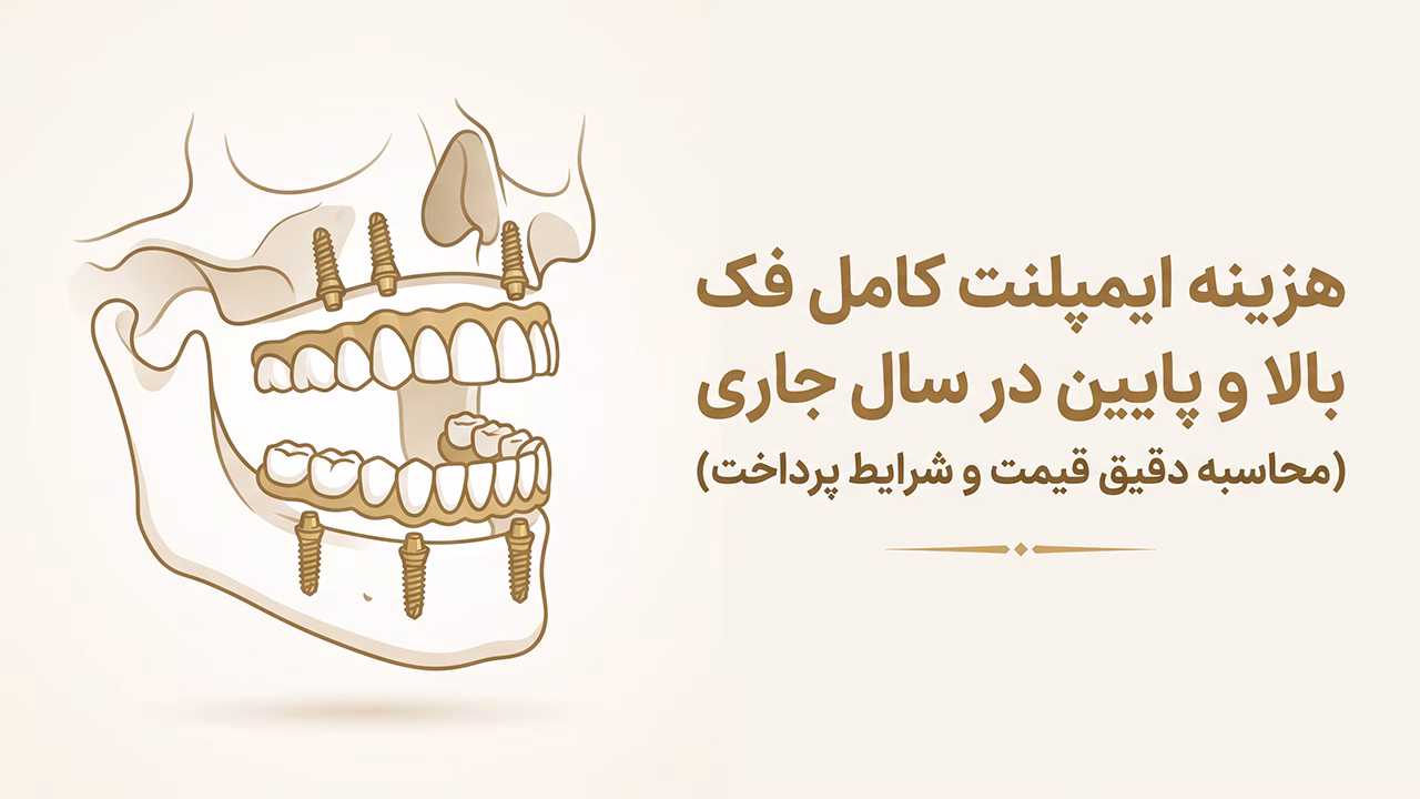 قیمت فک کامل ایمپلنت در شمال شرق تهران و بررسی هزینه‌ها