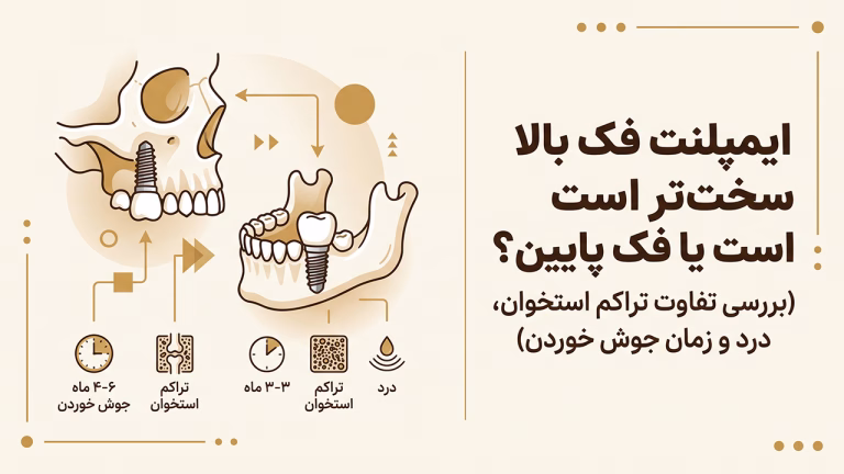 ایمپلنت فک بالا سخته یا پایین و مقایسه چالش‌های کاشت