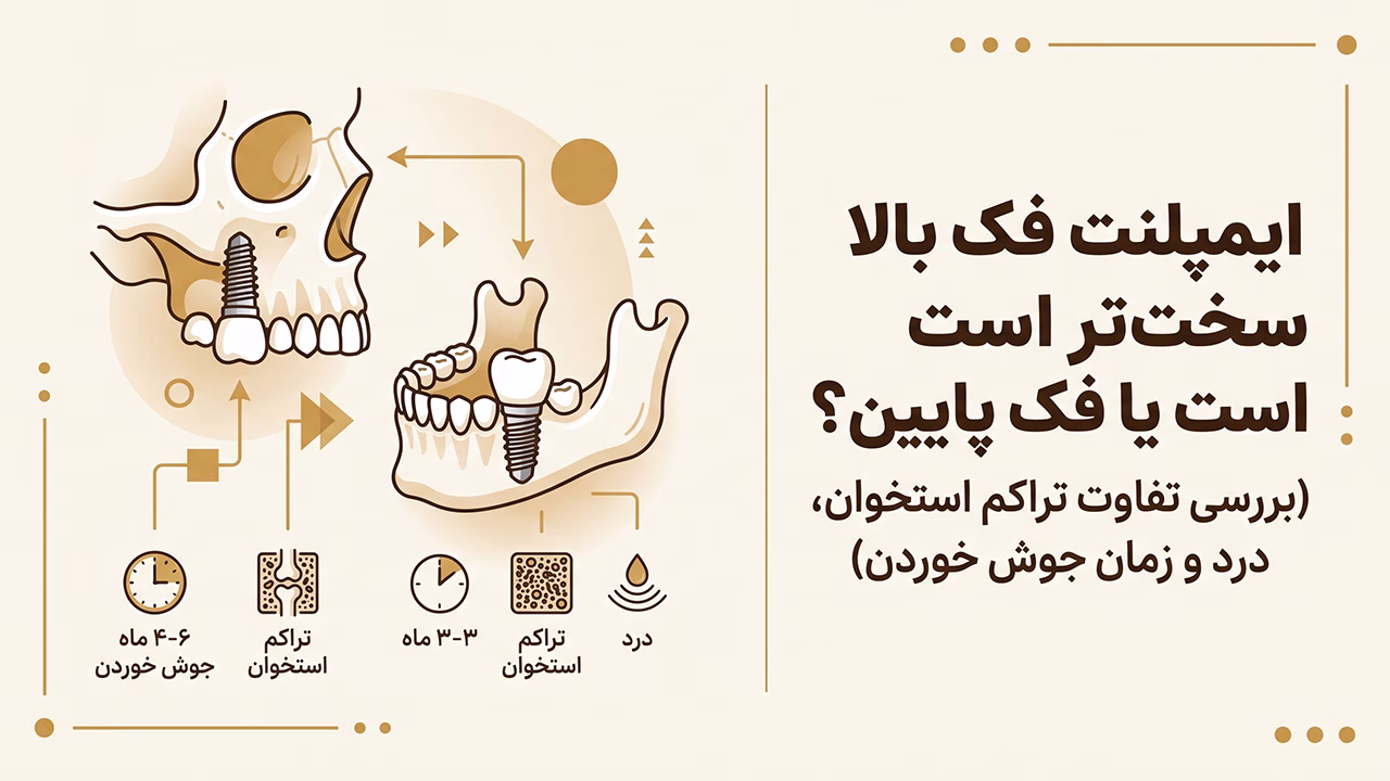 ایمپلنت فک بالا سخته یا پایین و مقایسه چالش‌های کاشت