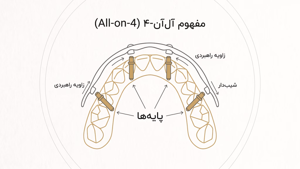 جراحی ایمپلنت کامل فک به روش All-on-4