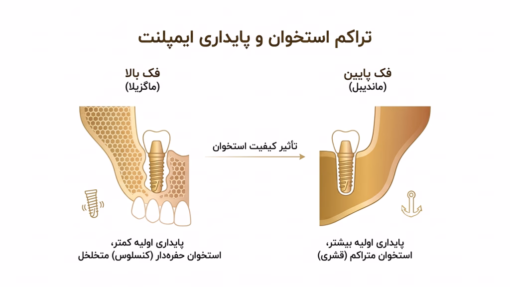 تفاوت تراکم استخوان فک بالا و پایین برای ایمپلنت