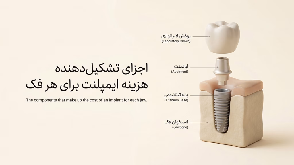 اجزای تشکیل دهنده هزینه ایمپلنت هر فک