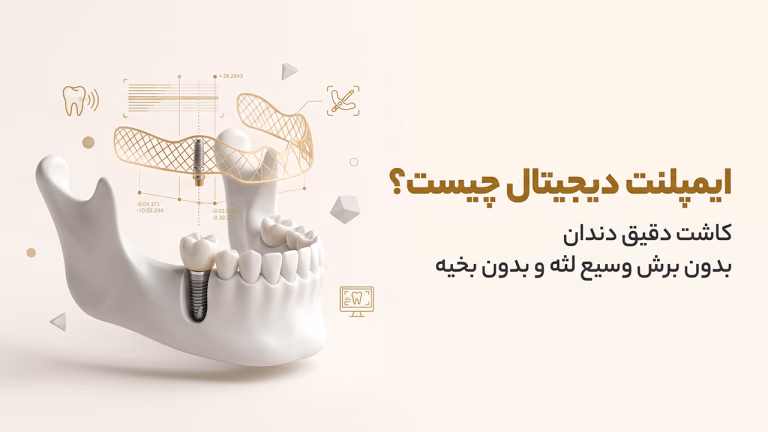 ایمپلنت دیجیتال فک بالا با شابلون جراحی سه بعدی