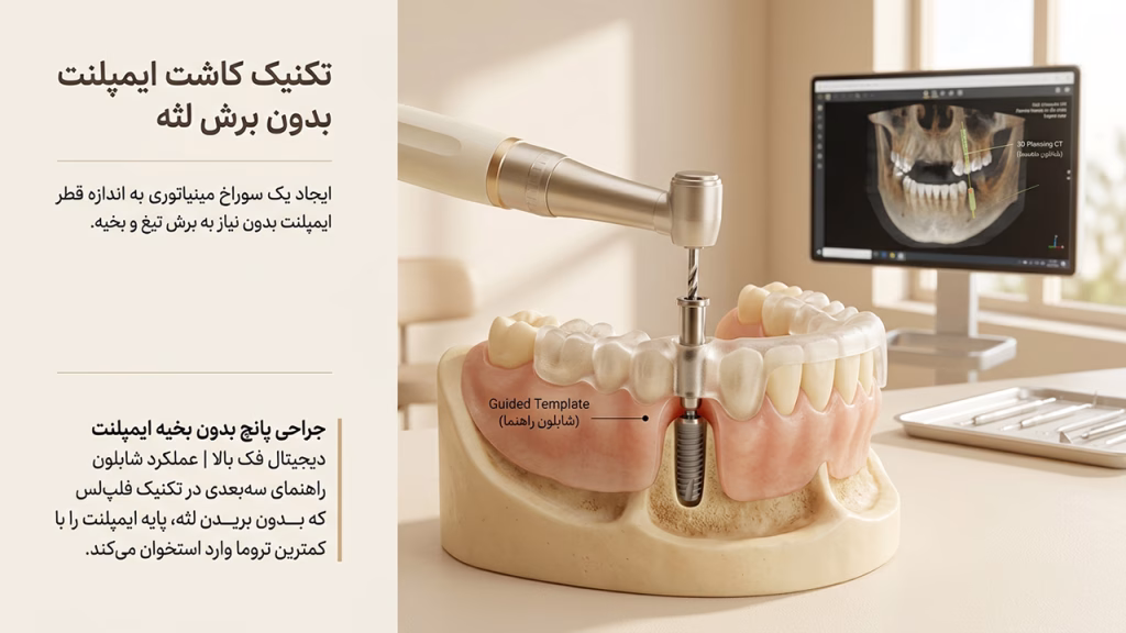 جراحی پانچ بدون بخیه ایمپلنت دیجیتال فک بالا