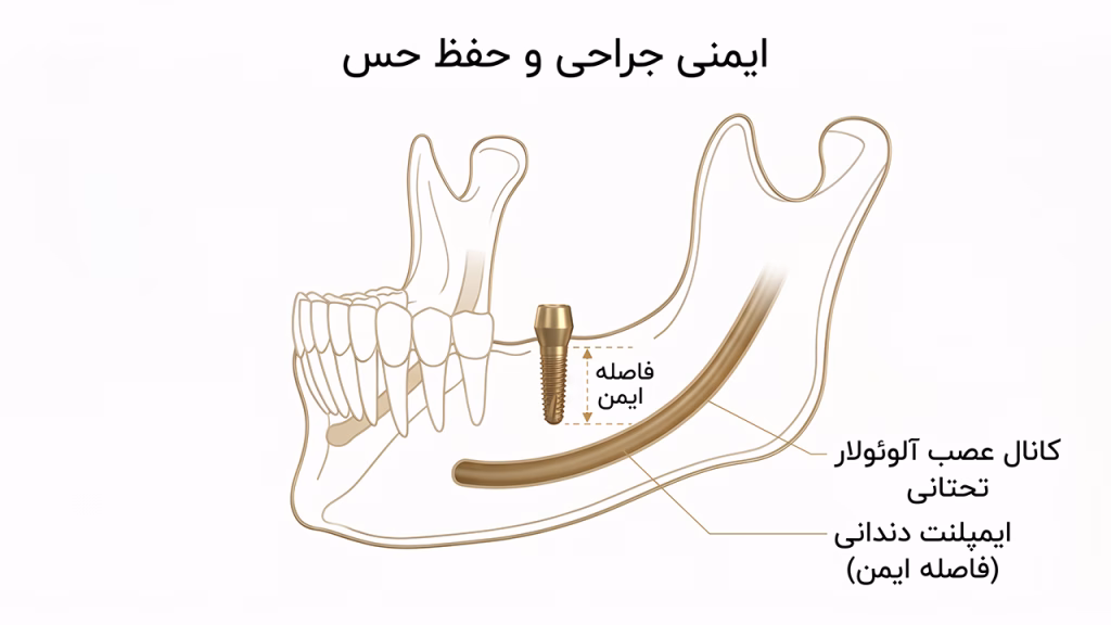 مسیر عصب آلوئولار تحتانی در جراحی ایمپلنت فک پایین