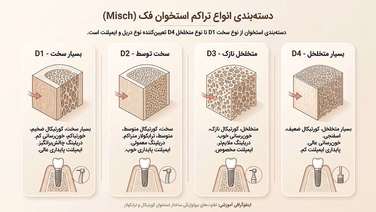 انواع تراکم استخوان فک از D1 تا D4 برای کاشت ایمپلنت