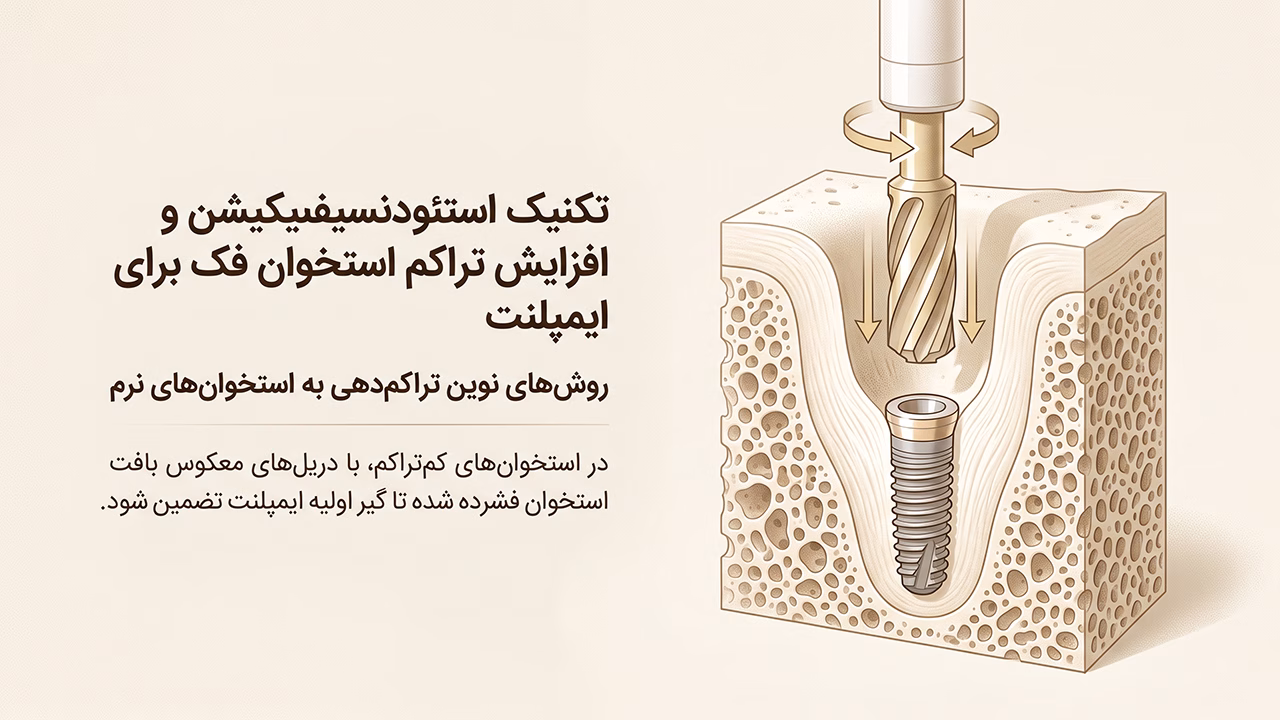 تکنیک استئودنسیفیکیشن و افزایش تراکم استخوان فک برای ایمپلنت