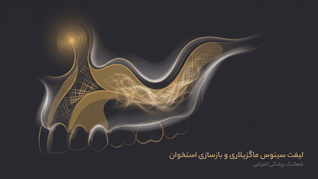 بازسازی استخوان و سینوس لیفت برای کاشت فک کامل ایمپلنت