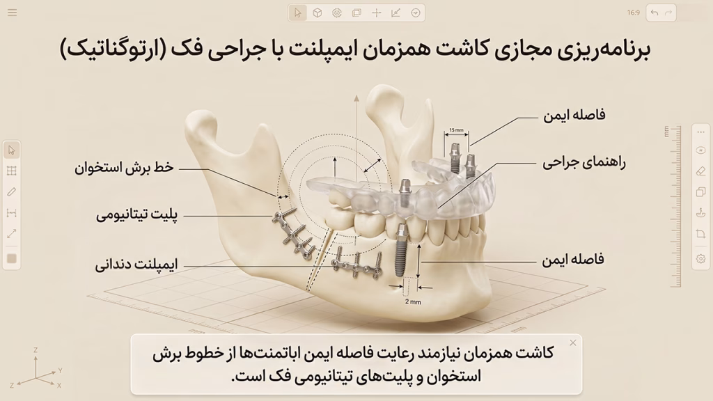 برنامه‌ریزی مجازی کاشت همزمان ایمپلنت با جراحی ارتوگناتیک فک