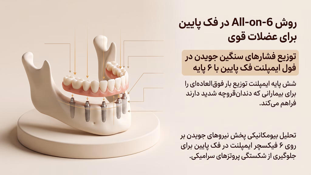 توزیع فشارهای سنگین جویدن در فول ایمپلنت فک پایین با ۶ پایه