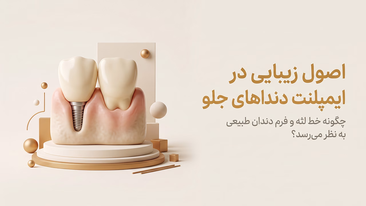 ایمپلنت دندان جلو فک بالا با خط لثه و فرم کاملاً طبیعی