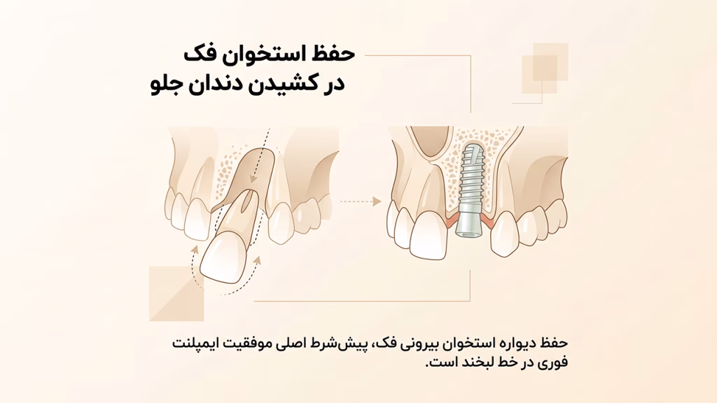 کشیدن دندان بدون آسیب به استخوان برای ایمپلنت فوری فک بالا