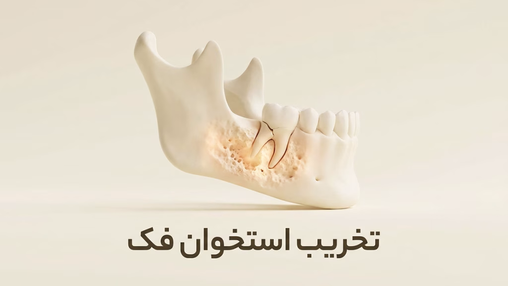 تخریب استخوان فک ناشی از ریشه دندان عفونی کشیده نشده