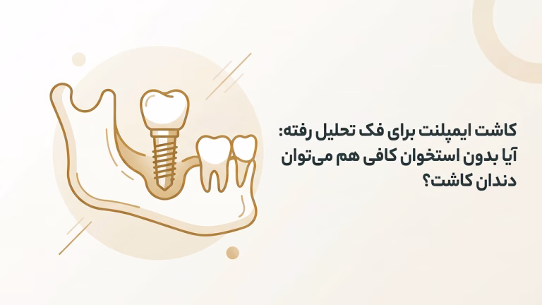 ایمپلنت برای فک تحلیل رفته و تکنیک‌های بازسازی استخوان