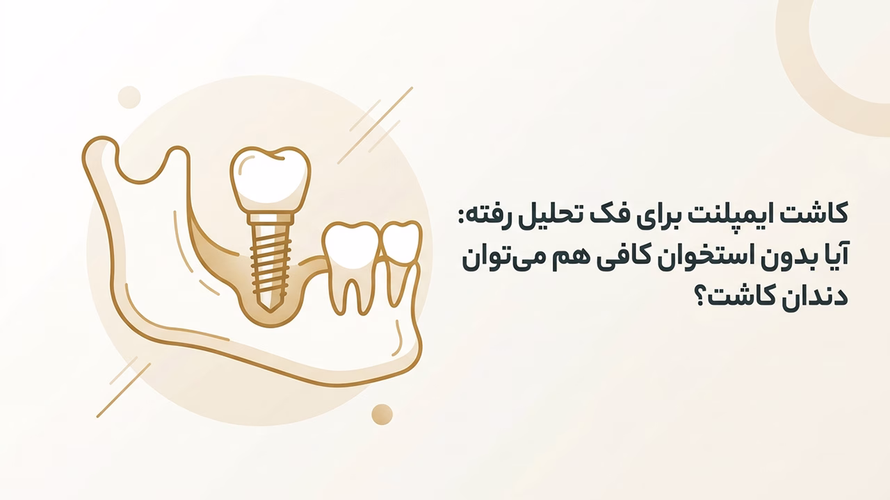 ایمپلنت برای فک تحلیل رفته و تکنیک‌های بازسازی استخوان