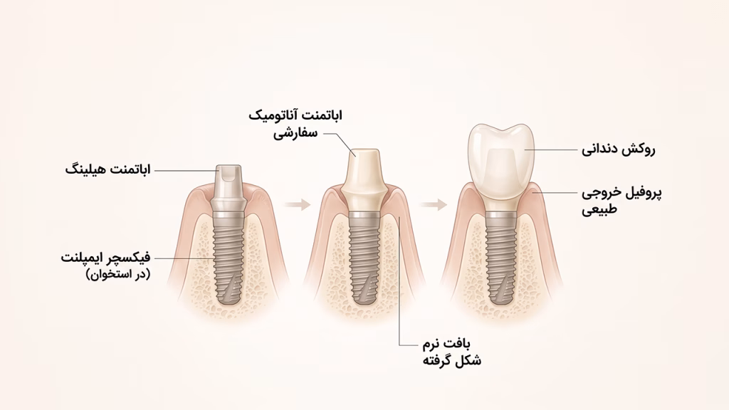 پروفایل خروج طبیعی در ایمپلنت دندان جلو فک بالا
