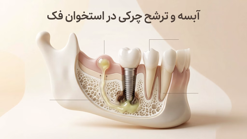 تشکیل فیستول چرکی و علائم عفونت استخوان فک