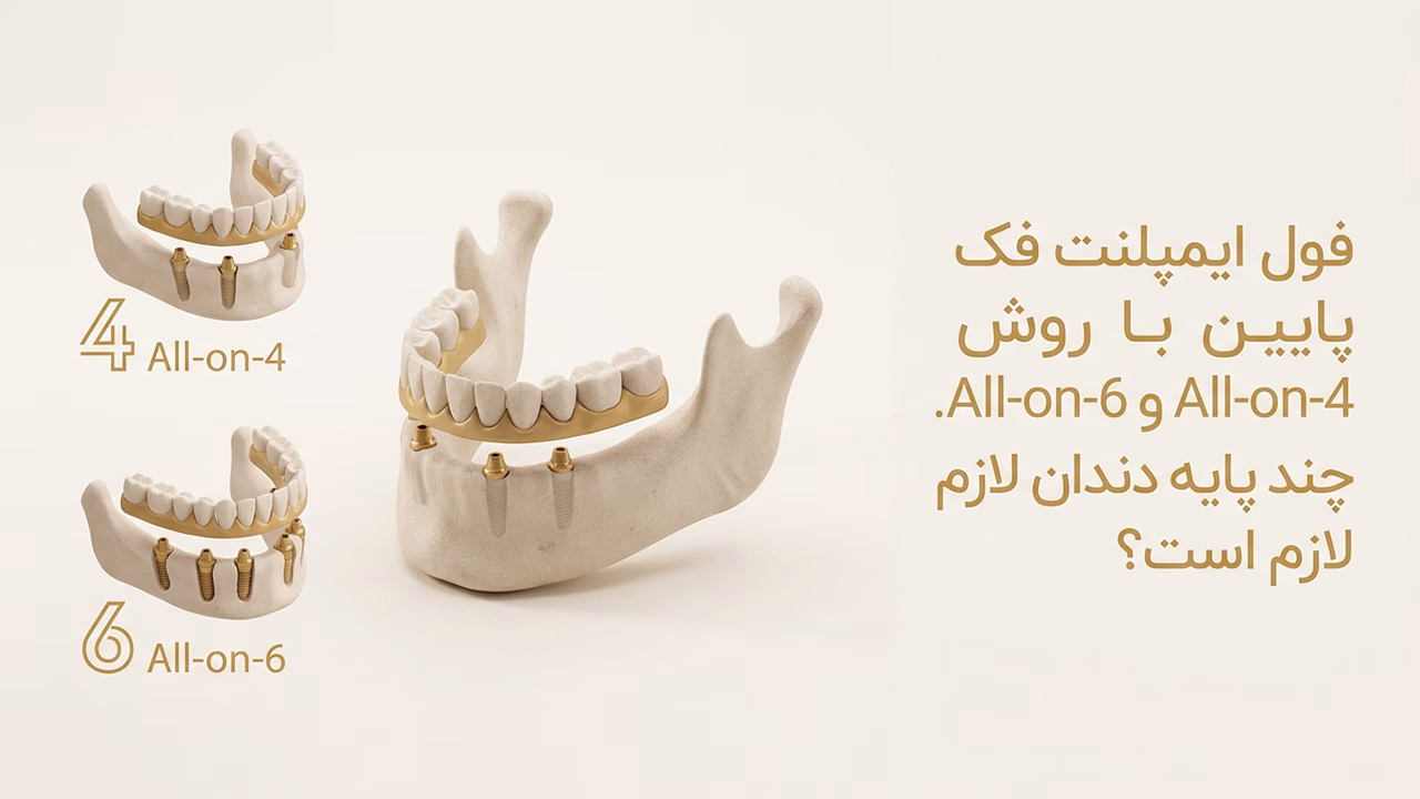 فول ایمپلنت فک پایین با روش‌های All-on-4 و All-on-6