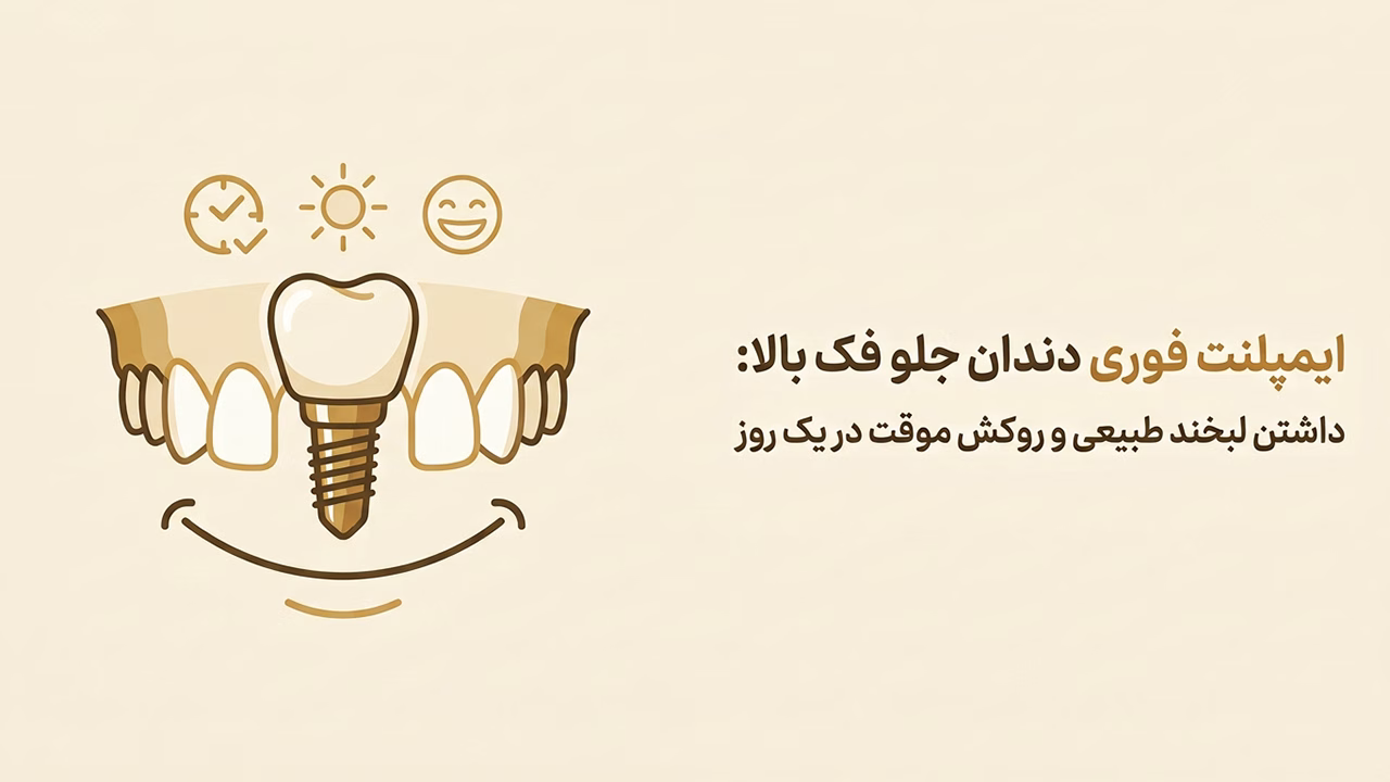 ایمپلنت فوری فک بالا و تحویل روکش در یک روز