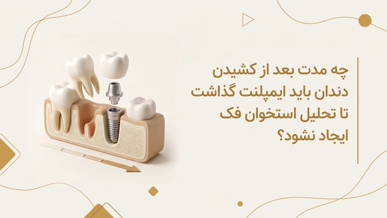 تحلیل استخوان فک بعد از کشیدن دندان و زمان طلایی کاشت ایمپلنت