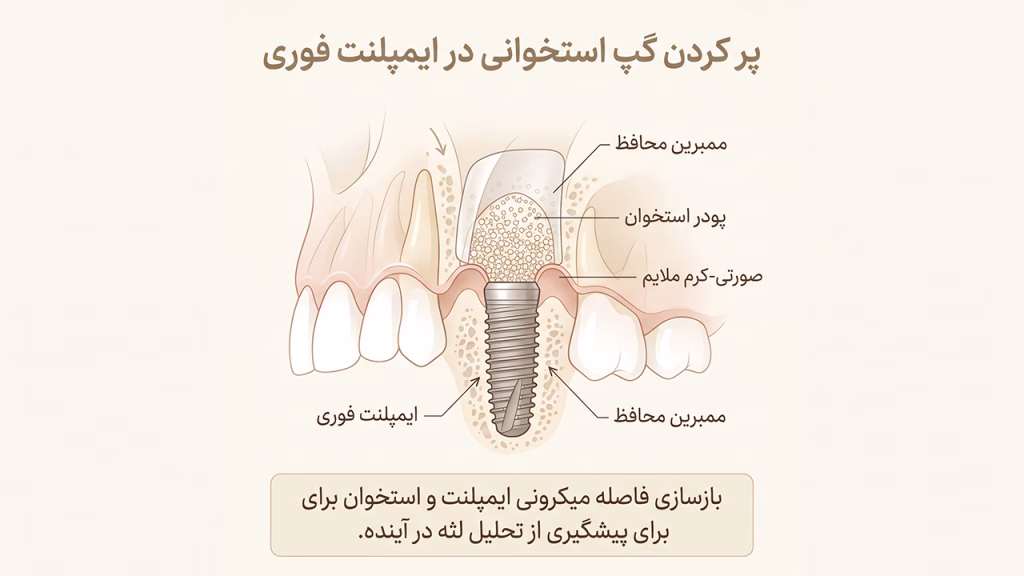پیوند پودر استخوان در فضای خالی ایمپلنت فوری فک بالا
