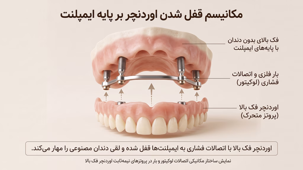 سیستم اتصالات اوردنچر فک بالا با پایه ایمپلنت و بار فلزی