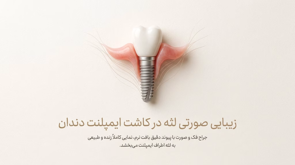 زیبایی خط لثه و مهندسی بافت نرم در ایمپلنت توسط متخصص