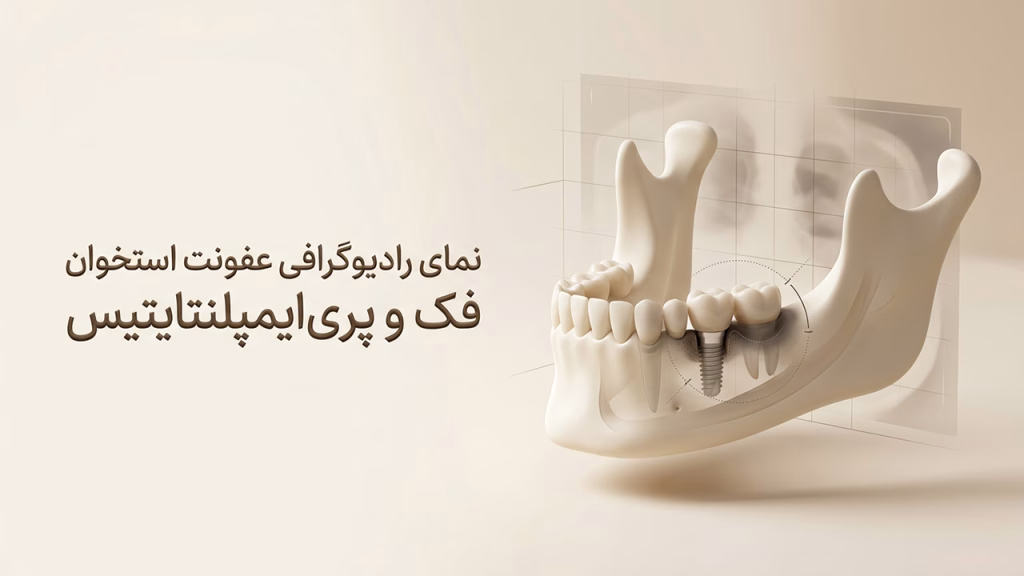 تحلیل استخوان در رادیوگرافی بر اثر عفونت استخوان فک