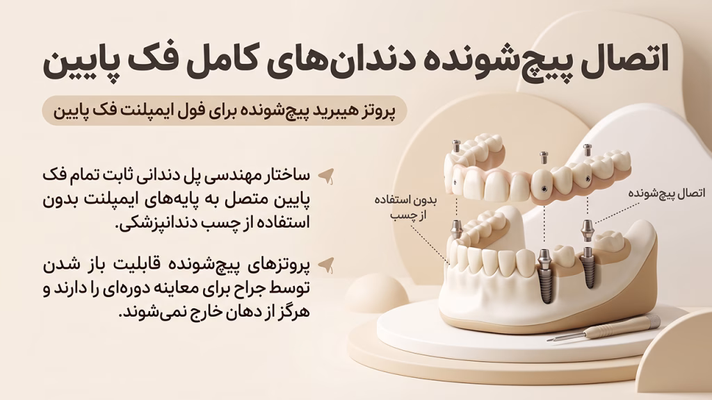 پروتز هیبرید پیچ‌شونده برای فول ایمپلنت فک پایین