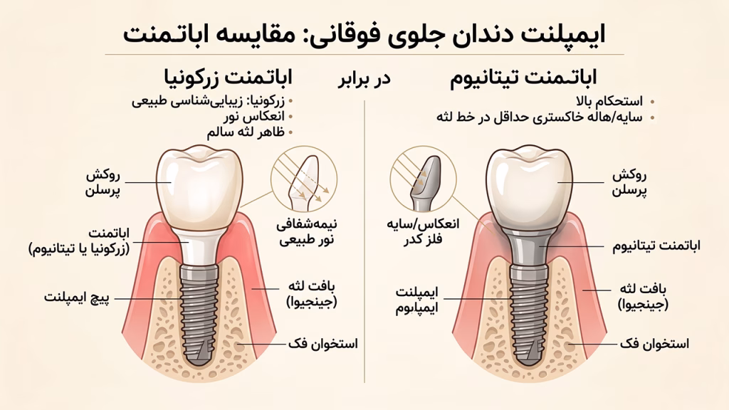 تفاوت اباتمنت زیرکونیا و تیتانیوم در ایمپلنت دندان جلو فک بالا