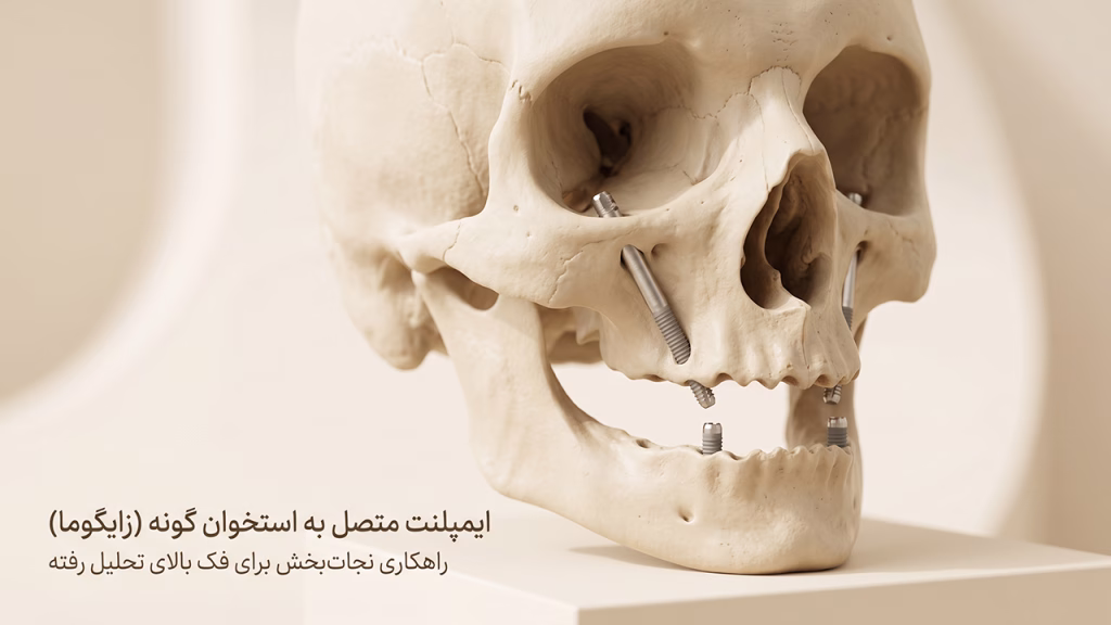 ایمپلنت زایگوماتیک برای فک بالای کاملا تحلیل رفته